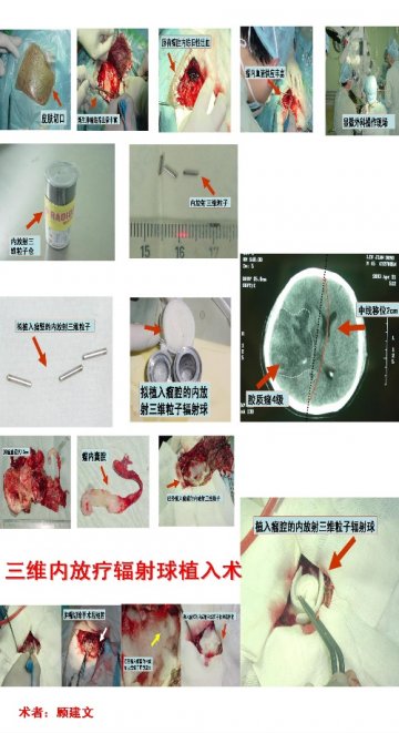 粒子刀治疗脑瘤