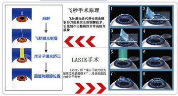 广西南宁飞秒激光治近视优势大盘点