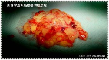 影像近似脑膜瘤的胶质瘤