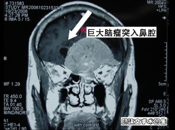 丧失嗅觉为特点的嗅沟脑膜瘤