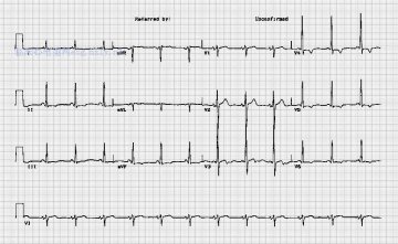 L-G-L综合症 Lown-Ganong-Levine Syndrome
