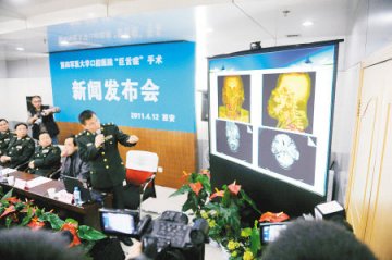 陕西宝鸡男子患“巨舌症” 21年舌头长到25厘米