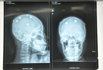 女孩头顶取出六枚“治病芯片” 医生提示癫痫病需正确就医