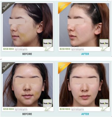 源自欧洲的童颜秘籍 – hus-hu法式童颜术