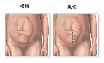 女性剖腹产手术全过程图解