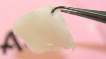 瑞典研究人员完成首例工程软骨鼻子重建手术