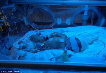 2岁男童发育不良酷似外星人