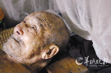 “漏斗胸”女孩手术失败夭折 刚出生就遭母亲抛弃