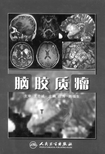 《脑胶质瘤》