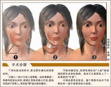 右脸先天凹陷女研究生变脸手术成功
