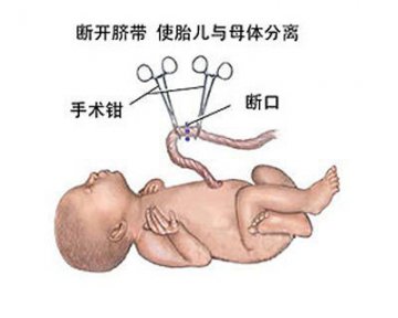 女性剖腹产手术全过程图解