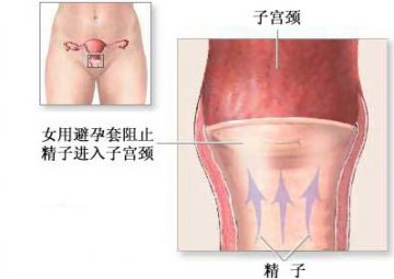 史上最全的9种避孕法
