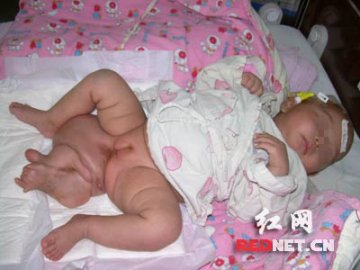 两个月婴儿屁股上长出一双脚