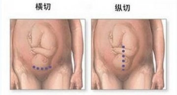 医学实录：女性剖腹产手术全过程