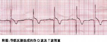 心电图伪差的识别判断