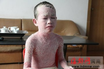 男孩患银屑病全身无完整皮 走到哪就脱到哪