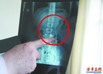小伙饭店用餐发现盘中有银色液珠 被测出汞中毒