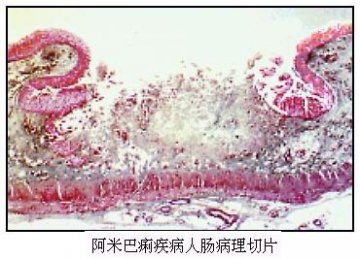 阿米巴痢疾病人肠病理切片