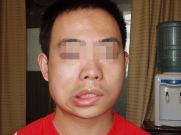 夏季面瘫爱找熬夜空调冷冻一族