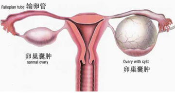中医外治法确实能调理卵巢囊肿