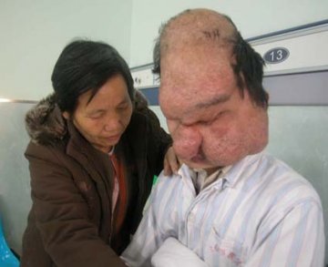 全球最恐怖的67种怪病