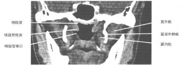 正常鼻咽鼻窦CT（7）