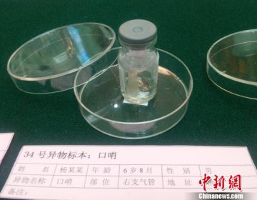 湖南展出儿童气管取出异物 呼吁家长提高防治意识