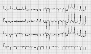 心房纤颤伴快速心室率Atrial fibrillation with rapid ventricular response