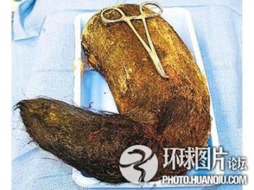 美国少女爱吃头发胃里取出9斤重毛团