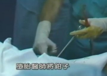 实拍：美国堕胎手术全过程
