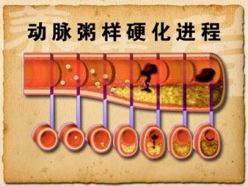 防动脉硬化，请记住三个关键词