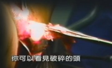 实拍：美国堕胎手术全过程