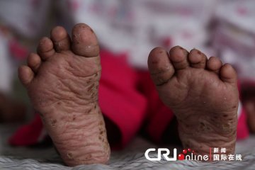 七岁女孩打针后患“黑肤怪病”