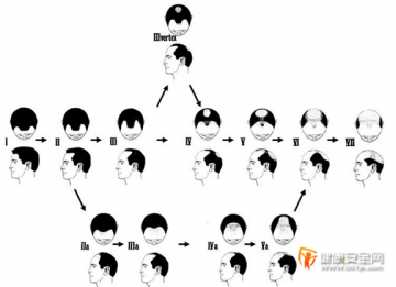 科发源：英王室“脱发基因”对继承人的影响