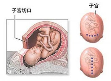 女性剖腹产手术全过程图解