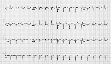 窦性心动过速Sinus tachycardia