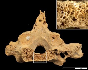 考古结果显示3000年前人类已受癌症之苦