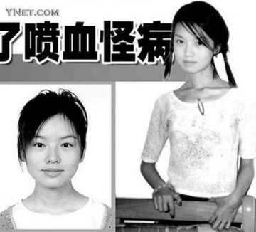 全球最恐怖的67种怪病
