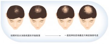 预防脱发有个“三字经”
