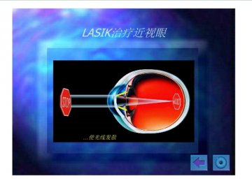 lasik6