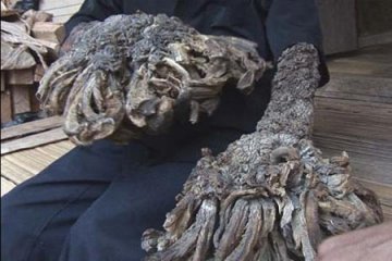 印尼半人半树男子可望治愈