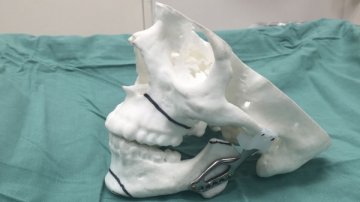3D打印进入人体：一个划时代的钛合金下巴