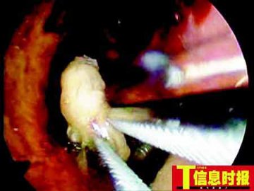 六旬汉鼻腔内孵出百条蝇蛆