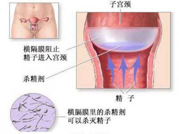 史上最全的9种避孕法