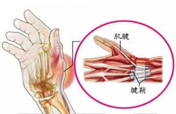不可小觑的“腱鞘炎”