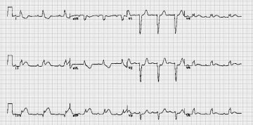 急性心肌梗塞伴左束支传导阻滞Acute myocardial infarction in the presence of left bundle branch block
