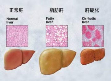 全国爱肝日：看看你容易患哪种脂肪肝？