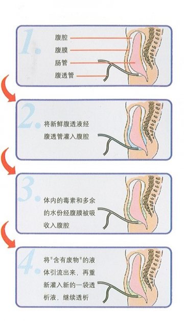 男子自制血透机透析13年 专家支招：腹膜透析可作为首选