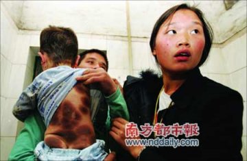 幼童患罕见疾病 全身大部分长满黑斑