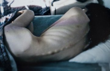 厌食症女孩的真实生活